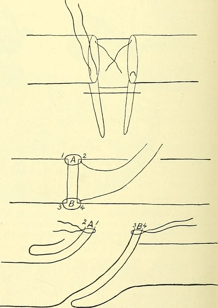 An illustration from Modern surgery, general and operative / by John Chalmers Da Costa., 1907, leaf 974