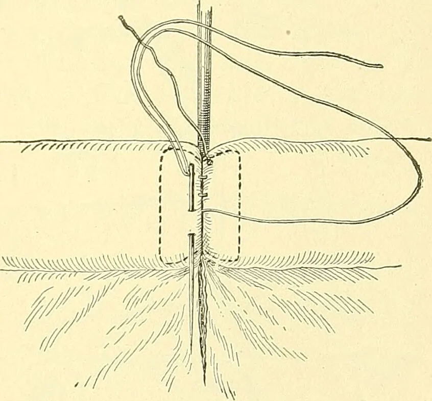 An illustration from Modern surgery, general and operative / by John Chalmers Da Costa., 1907, leaf 975