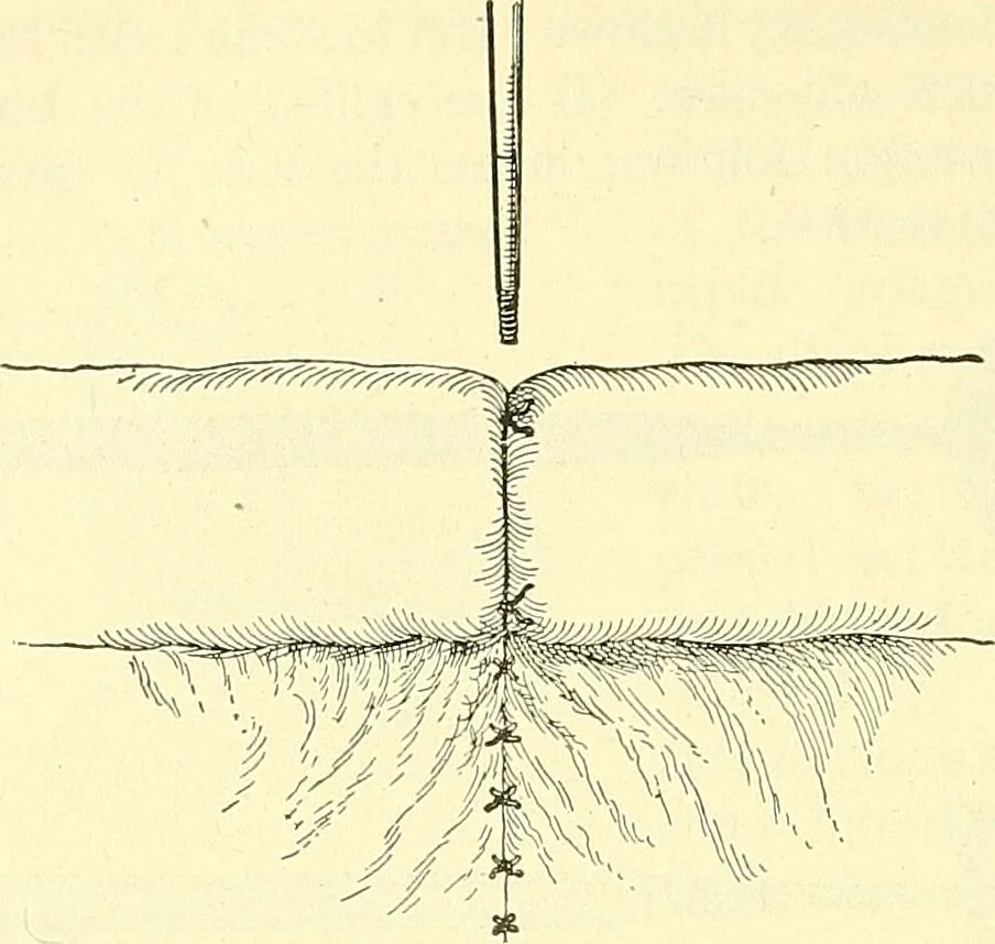 An illustration from Modern surgery, general and operative / by John Chalmers Da Costa., 1907, leaf 976