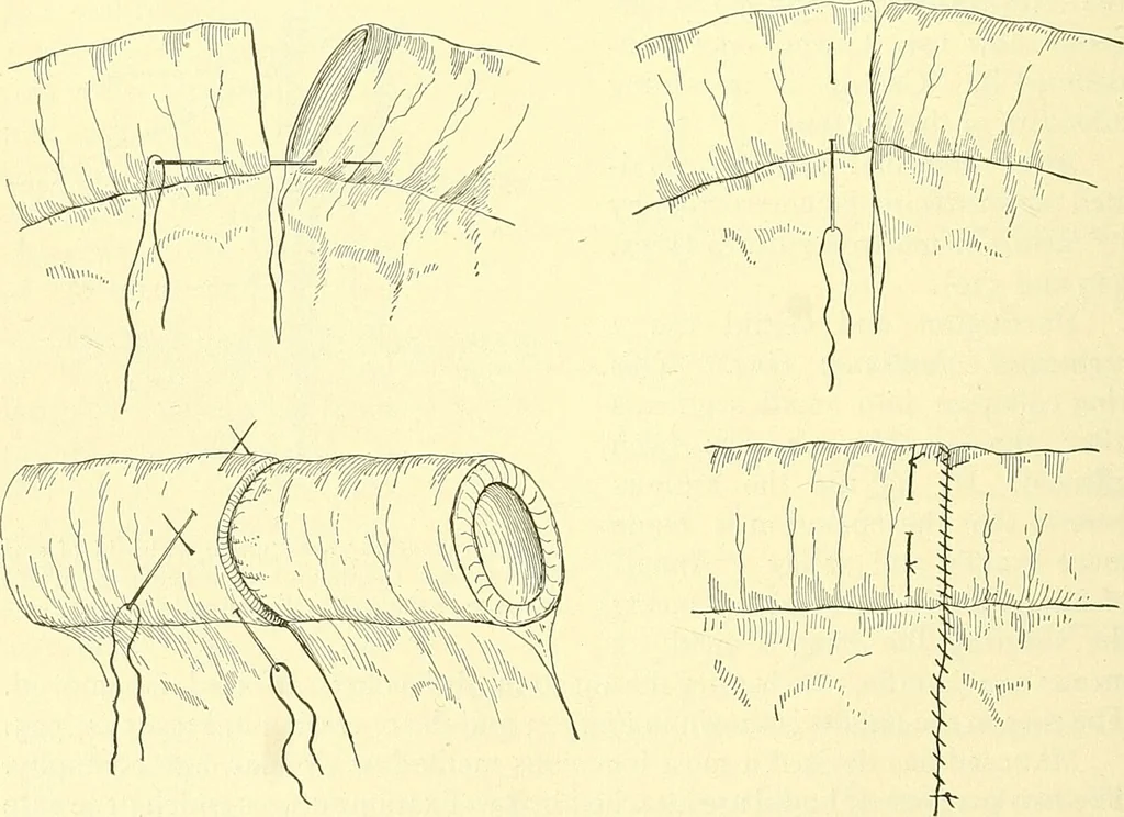 An illustration from Modern surgery, general and operative / by John Chalmers Da Costa., 1907, leaf 976