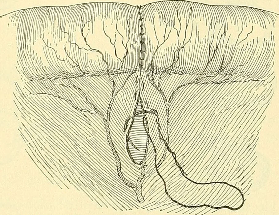 An illustration from Modern surgery, general and operative / by John Chalmers Da Costa., 1907, leaf 977
