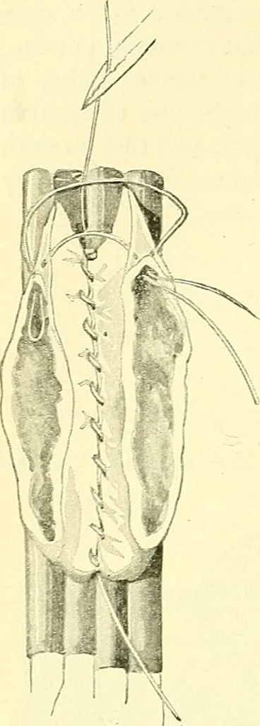 An illustration from Modern surgery, general and operative / by John Chalmers Da Costa., 1907, leaf 978