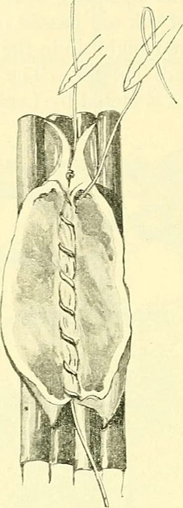 An illustration from Modern surgery, general and operative / by John Chalmers Da Costa., 1907, leaf 978