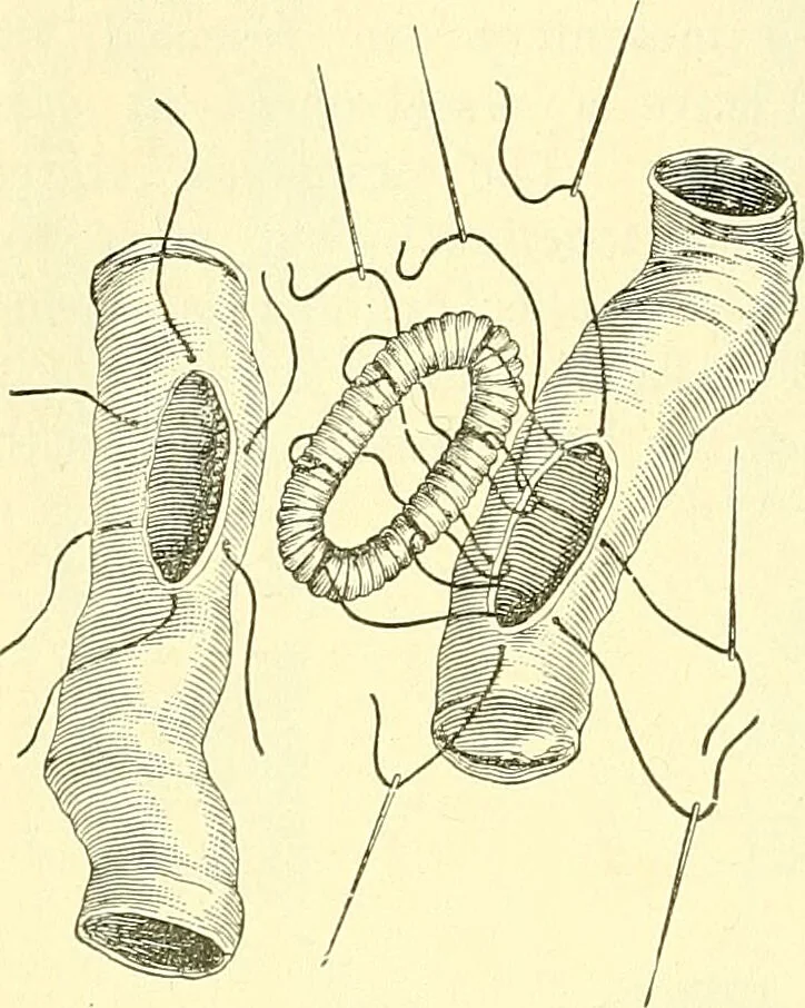 An illustration from Modern surgery, general and operative / by John Chalmers Da Costa., 1907, leaf 980