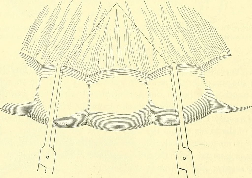 An illustration from Modern surgery, general and operative / by John Chalmers Da Costa., 1907, leaf 980