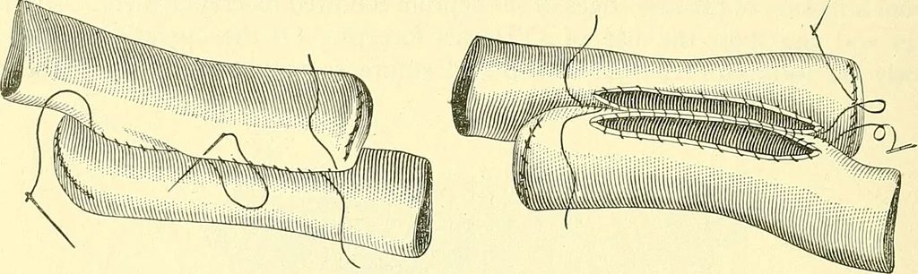 An illustration from Modern surgery, general and operative / by John Chalmers Da Costa., 1907, leaf 982
