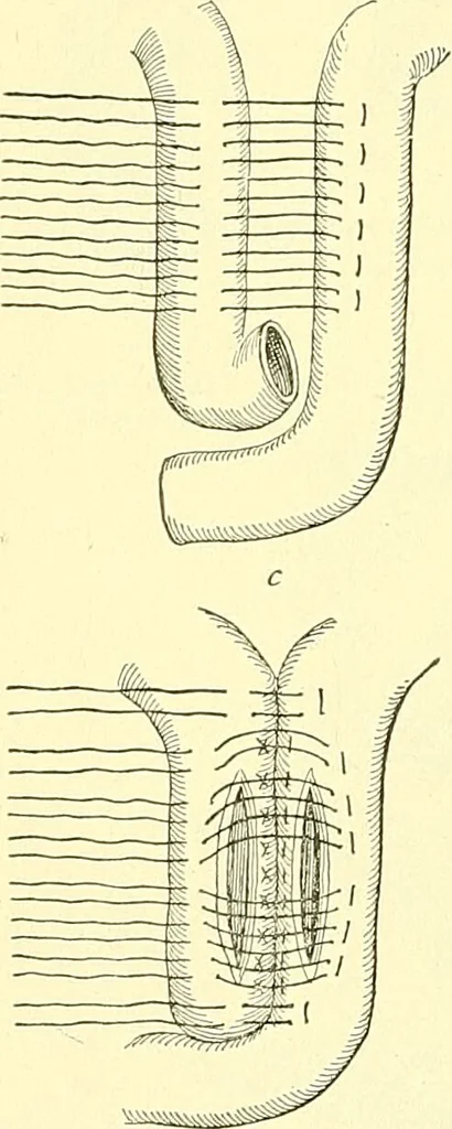 An illustration from Modern surgery, general and operative / by John Chalmers Da Costa., 1907, leaf 982