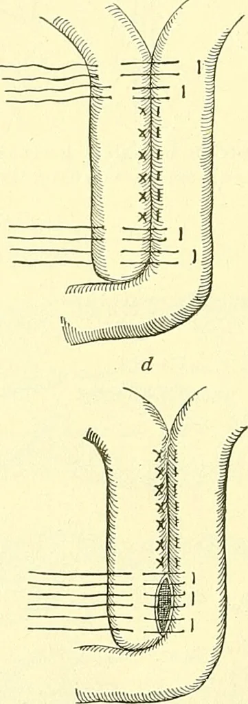 An illustration from Modern surgery, general and operative / by John Chalmers Da Costa., 1907, leaf 982