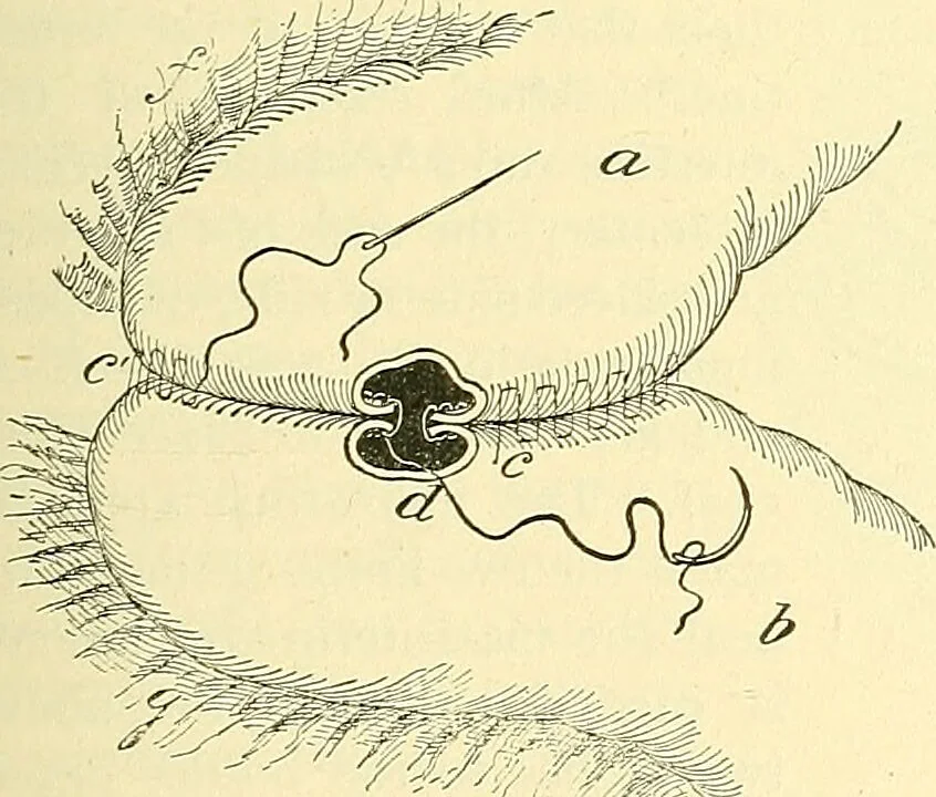 An illustration from Modern surgery, general and operative / by John Chalmers Da Costa., 1907, leaf 983