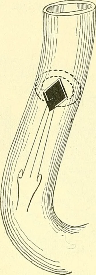 An illustration from Modern surgery, general and operative / by John Chalmers Da Costa., 1907, leaf 984