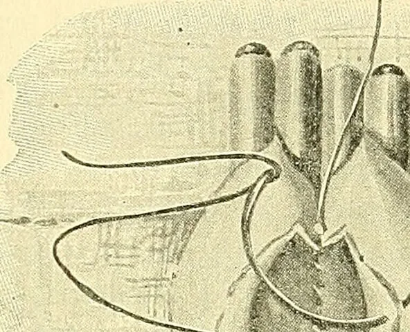 An illustration from Modern surgery, general and operative / by John Chalmers Da Costa., 1907, leaf 985
