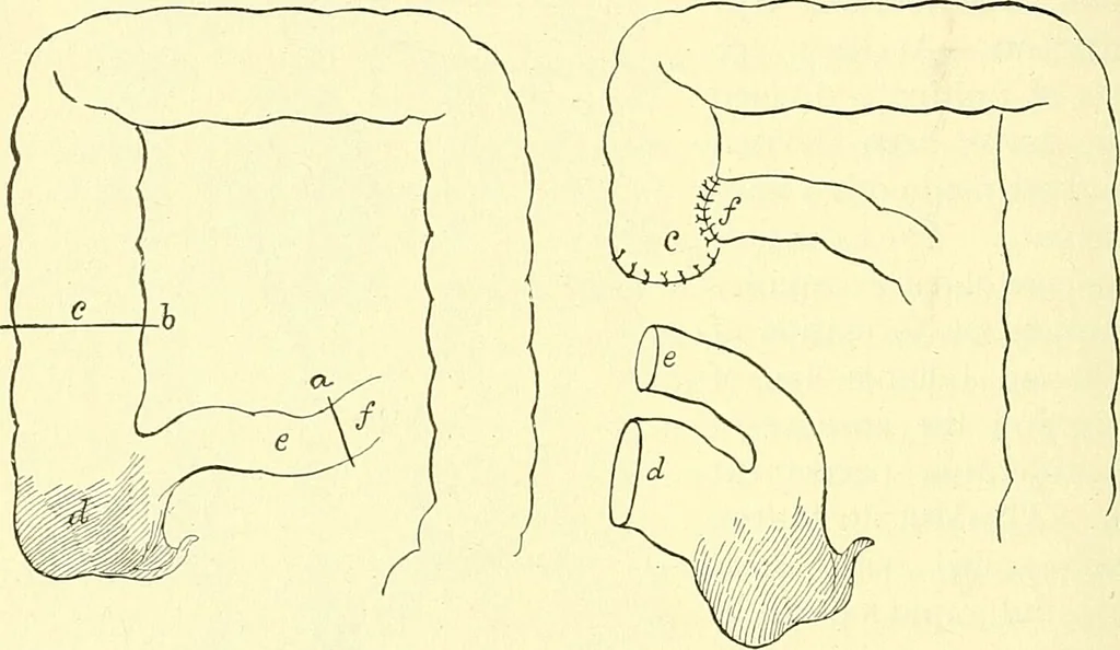 An illustration from Modern surgery, general and operative / by John Chalmers Da Costa., 1907, leaf 986