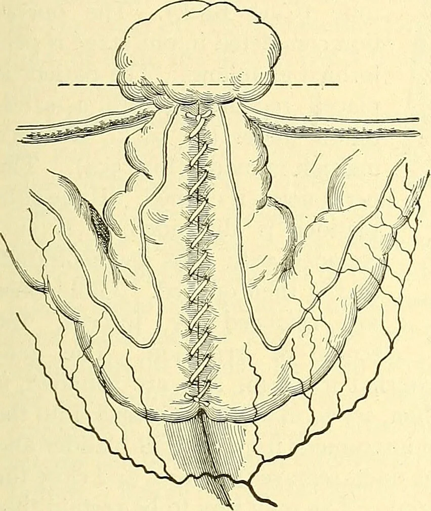 An illustration from Modern surgery, general and operative / by John Chalmers Da Costa., 1907, leaf 991