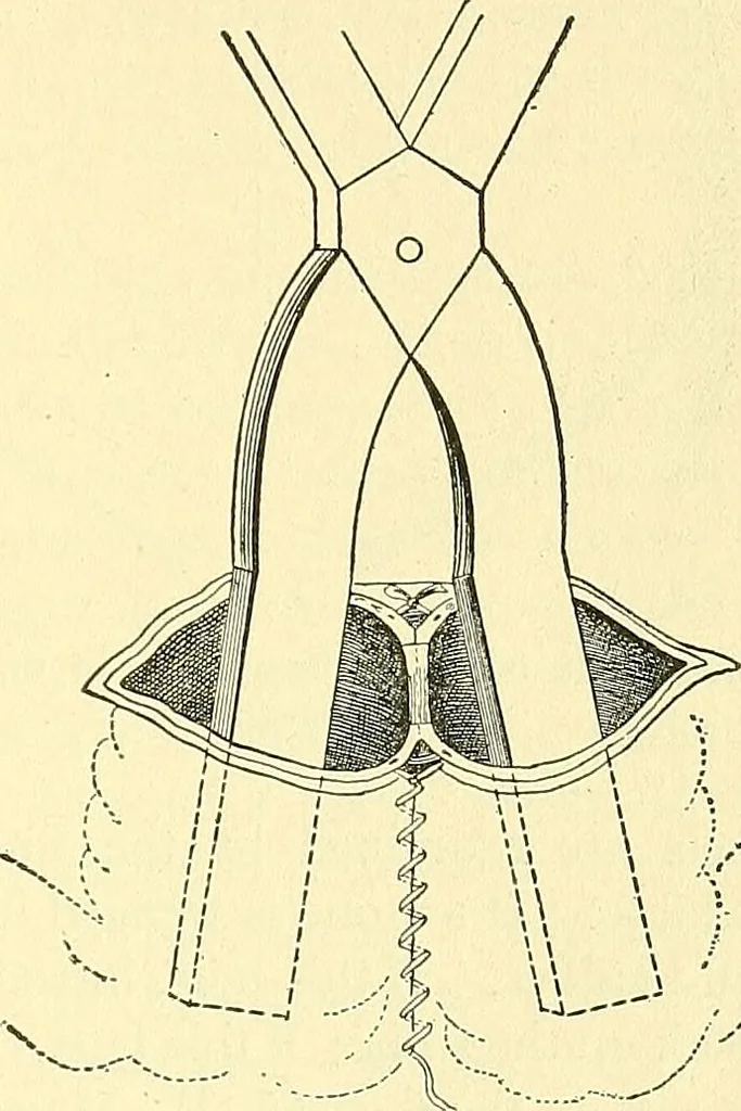 An illustration from Modern surgery, general and operative / by John Chalmers Da Costa., 1907, leaf 991