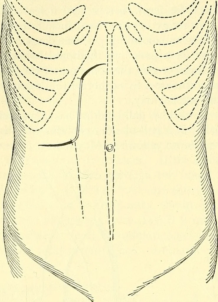 An illustration from Modern surgery, general and operative / by John Chalmers Da Costa., 1907, leaf 992