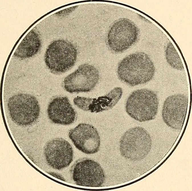 An illustration from The malarial fevers, haemoglobinuric fever and the blood protozoa of man / by Charles F. Craig ; illustrated by four colored plates, twenty-five clinical charts, and twenty-eight photomicrographs and drawings., 1909, leaf 85