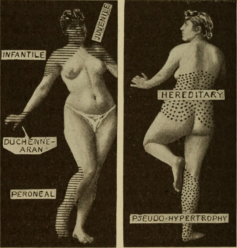 An illustration from The diagnostics of internal medicine : a clinical treatise upon the recognised principles of medical diagnosis, prepared for the use of students and practitioners of medicine / by Glentworth Reeve Butler ... ; with five coloured plates and two hundred and seventy-two illustrations and charts in the text., 1909, leaf 1106