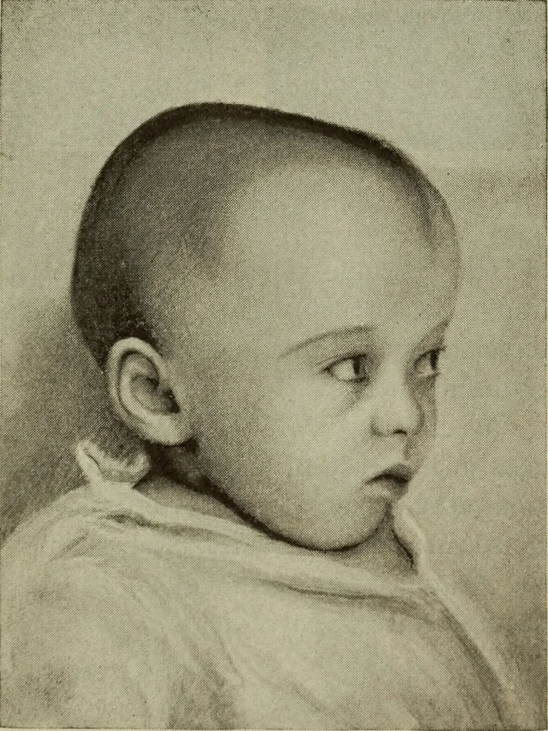 An illustration from The diagnostics of internal medicine : a clinical treatise upon the recognised principles of medical diagnosis, prepared for the use of students and practitioners of medicine / by Glentworth Reeve Butler ... ; with five coloured plates and two hundred and seventy-two illustrations and charts in the text., 1909, leaf 213