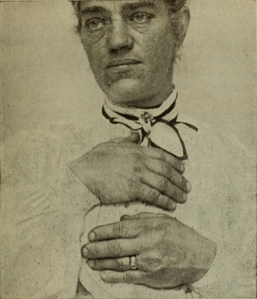 An illustration from The diagnostics of internal medicine : a clinical treatise upon the recognised principles of medical diagnosis, prepared for the use of students and practitioners of medicine / by Glentworth Reeve Butler ... ; with five coloured plates and two hundred and seventy-two illustrations and charts in the text., 1909, leaf 215