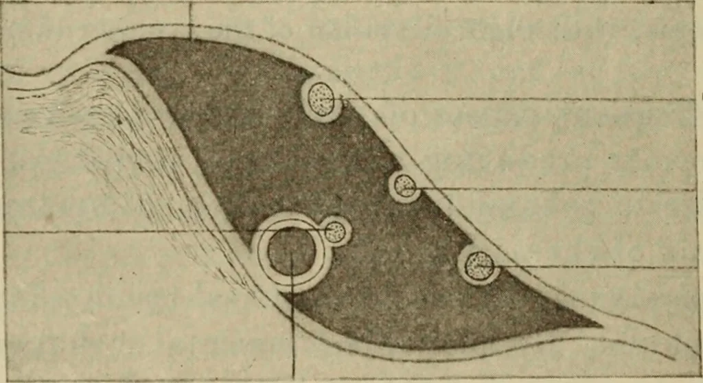 An illustration from The diagnostics of internal medicine : a clinical treatise upon the recognised principles of medical diagnosis, prepared for the use of students and practitioners of medicine / by Glentworth Reeve Butler ... ; with five coloured plates and two hundred and seventy-two illustrations and charts in the text., 1909, leaf 256
