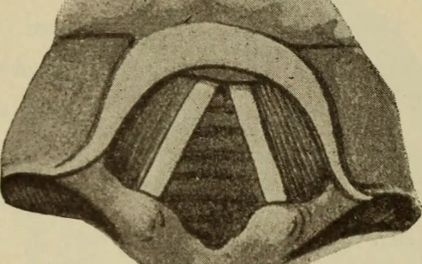 An illustration from The diagnostics of internal medicine : a clinical treatise upon the recognised principles of medical diagnosis, prepared for the use of students and practitioners of medicine / by Glentworth Reeve Butler ... ; with five coloured plates and two hundred and seventy-two illustrations and charts in the text., 1909, leaf 300