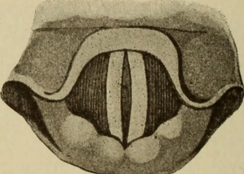 An illustration from The diagnostics of internal medicine : a clinical treatise upon the recognised principles of medical diagnosis, prepared for the use of students and practitioners of medicine / by Glentworth Reeve Butler ... ; with five coloured plates and two hundred and seventy-two illustrations and charts in the text., 1909, leaf 300