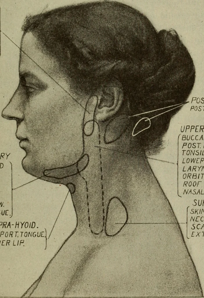 An illustration from The diagnostics of internal medicine : a clinical treatise upon the recognised principles of medical diagnosis, prepared for the use of students and practitioners of medicine / by Glentworth Reeve Butler ... ; with five coloured plates and two hundred and seventy-two illustrations and charts in the text., 1909, leaf 325