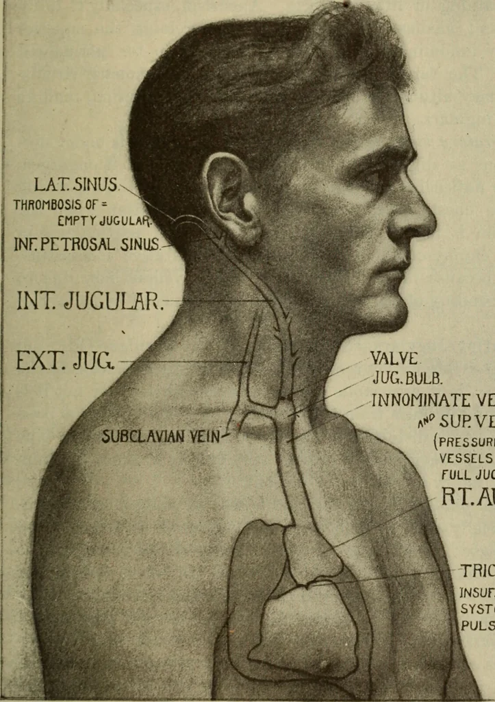An illustration from The diagnostics of internal medicine : a clinical treatise upon the recognised principles of medical diagnosis, prepared for the use of students and practitioners of medicine / by Glentworth Reeve Butler ... ; with five coloured plates and two hundred and seventy-two illustrations and charts in the text., 1909, leaf 327