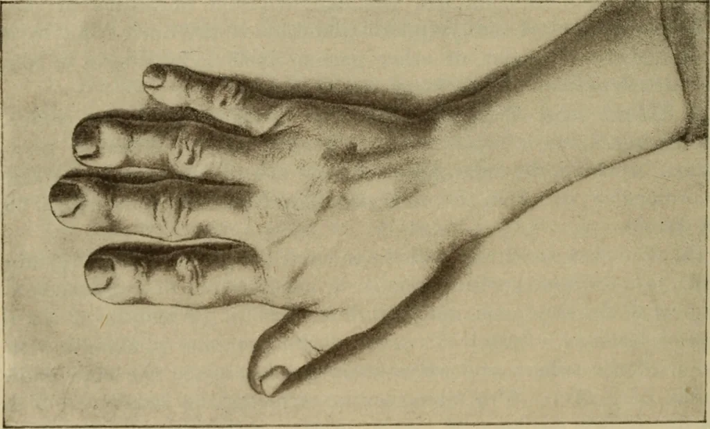 An illustration from The diagnostics of internal medicine : a clinical treatise upon the recognised principles of medical diagnosis, prepared for the use of students and practitioners of medicine / by Glentworth Reeve Butler ... ; with five coloured plates and two hundred and seventy-two illustrations and charts in the text., 1909, leaf 332