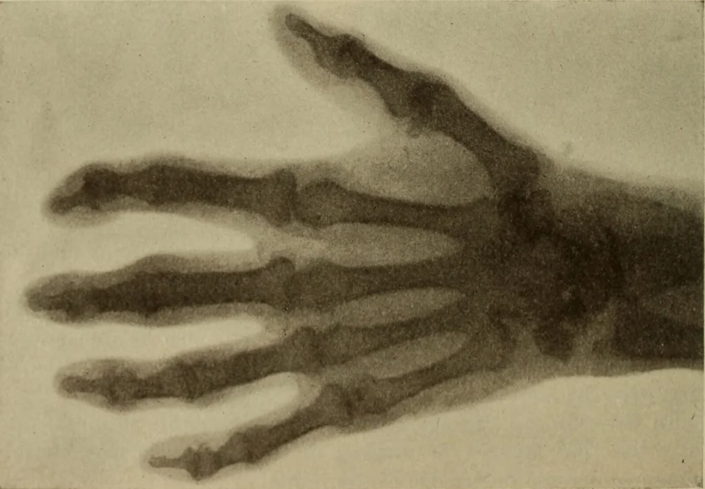An illustration from The diagnostics of internal medicine : a clinical treatise upon the recognised principles of medical diagnosis, prepared for the use of students and practitioners of medicine / by Glentworth Reeve Butler ... ; with five coloured plates and two hundred and seventy-two illustrations and charts in the text., 1909, leaf 336