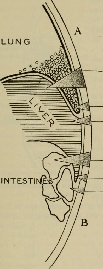 An illustration from The diagnostics of internal medicine : a clinical treatise upon the recognised principles of medical diagnosis, prepared for the use of students and practitioners of medicine / by Glentworth Reeve Butler ... ; with five coloured plates and two hundred and seventy-two illustrations and charts in the text., 1909, leaf 351