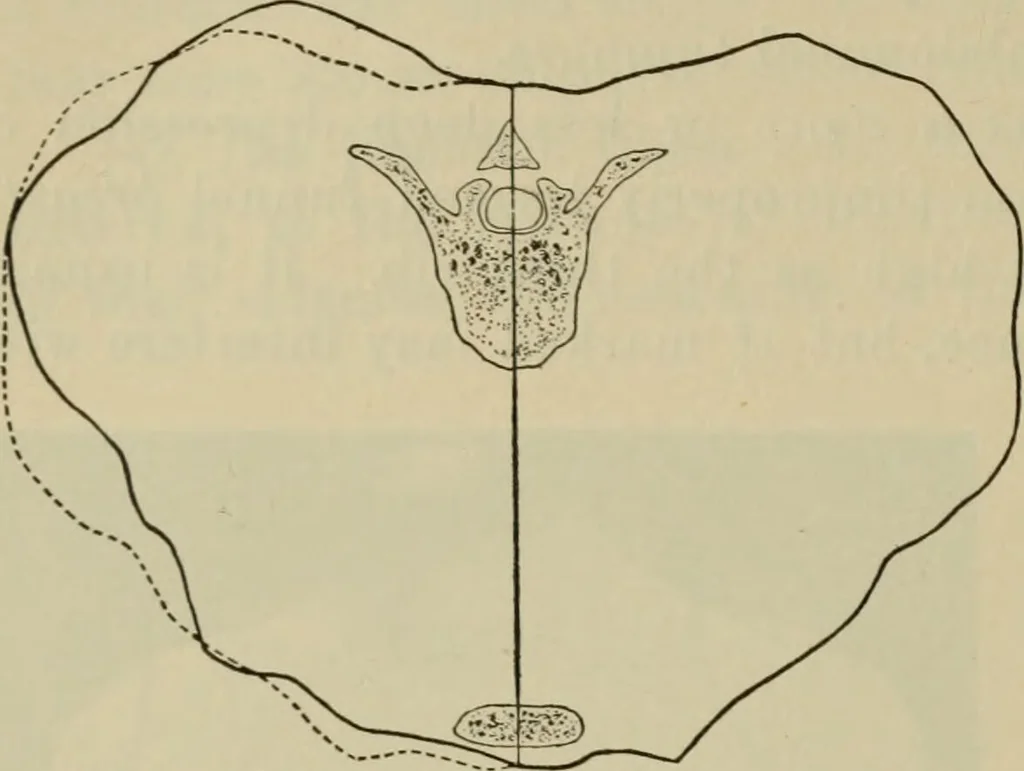 An illustration from The diagnostics of internal medicine : a clinical treatise upon the recognised principles of medical diagnosis, prepared for the use of students and practitioners of medicine / by Glentworth Reeve Butler ... ; with five coloured plates and two hundred and seventy-two illustrations and charts in the text., 1909, leaf 362