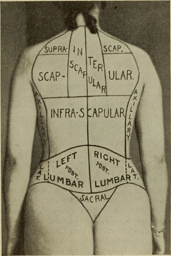 An illustration from The diagnostics of internal medicine : a clinical treatise upon the recognised principles of medical diagnosis, prepared for the use of students and practitioners of medicine / by Glentworth Reeve Butler ... ; with five coloured plates and two hundred and seventy-two illustrations and charts in the text., 1909, leaf 367