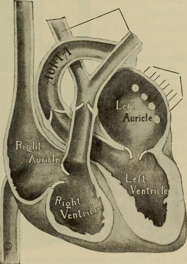 An illustration from The diagnostics of internal medicine : a clinical treatise upon the recognised principles of medical diagnosis, prepared for the use of students and practitioners of medicine / by Glentworth Reeve Butler ... ; with five coloured plates and two hundred and seventy-two illustrations and charts in the text., 1909, leaf 375
