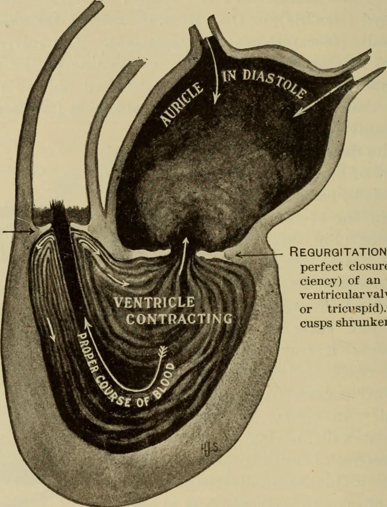 An illustration from The diagnostics of internal medicine : a clinical treatise upon the recognised principles of medical diagnosis, prepared for the use of students and practitioners of medicine / by Glentworth Reeve Butler ... ; with five coloured plates and two hundred and seventy-two illustrations and charts in the text., 1909, leaf 376