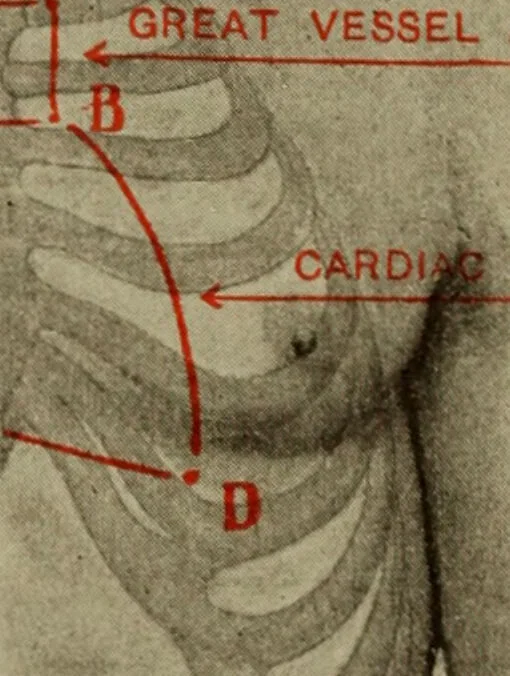 An illustration from The diagnostics of internal medicine : a clinical treatise upon the recognised principles of medical diagnosis, prepared for the use of students and practitioners of medicine / by Glentworth Reeve Butler ... ; with five coloured plates and two hundred and seventy-two illustrations and charts in the text., 1909, leaf 382