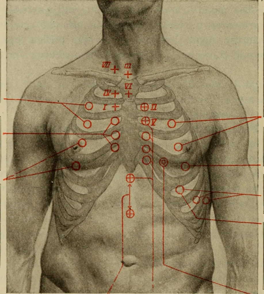 An illustration from The diagnostics of internal medicine : a clinical treatise upon the recognised principles of medical diagnosis, prepared for the use of students and practitioners of medicine / by Glentworth Reeve Butler ... ; with five coloured plates and two hundred and seventy-two illustrations and charts in the text., 1909, leaf 388
