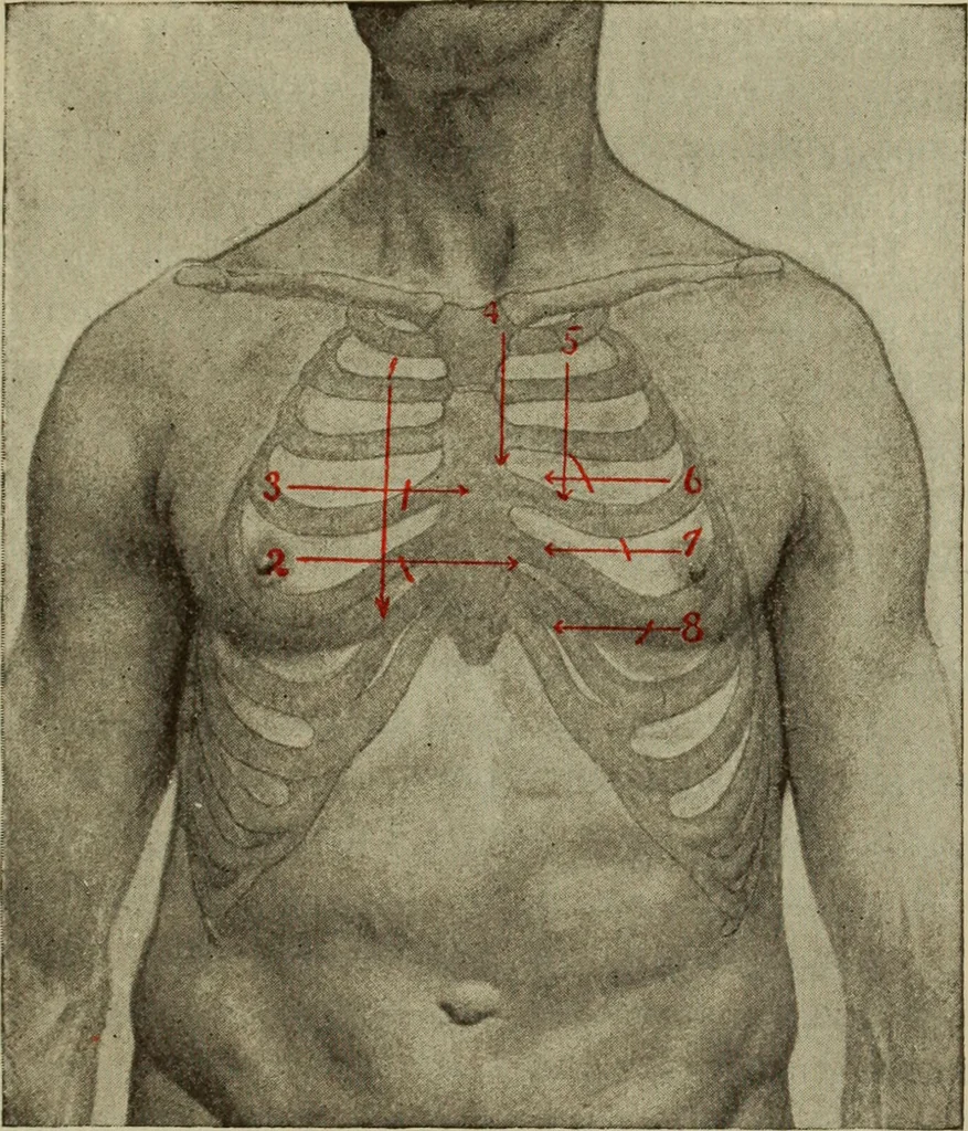 An illustration from The diagnostics of internal medicine : a clinical treatise upon the recognised principles of medical diagnosis, prepared for the use of students and practitioners of medicine / by Glentworth Reeve Butler ... ; with five coloured plates and two hundred and seventy-two illustrations and charts in the text., 1909, leaf 395