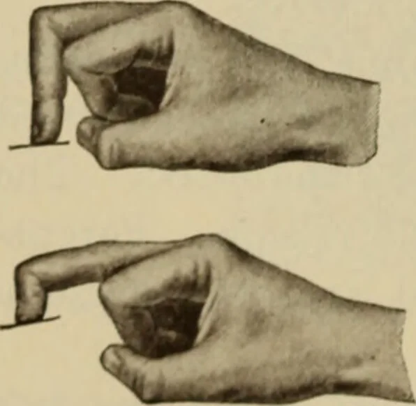 An illustration from The diagnostics of internal medicine : a clinical treatise upon the recognised principles of medical diagnosis, prepared for the use of students and practitioners of medicine / by Glentworth Reeve Butler ... ; with five coloured plates and two hundred and seventy-two illustrations and charts in the text., 1909, leaf 396