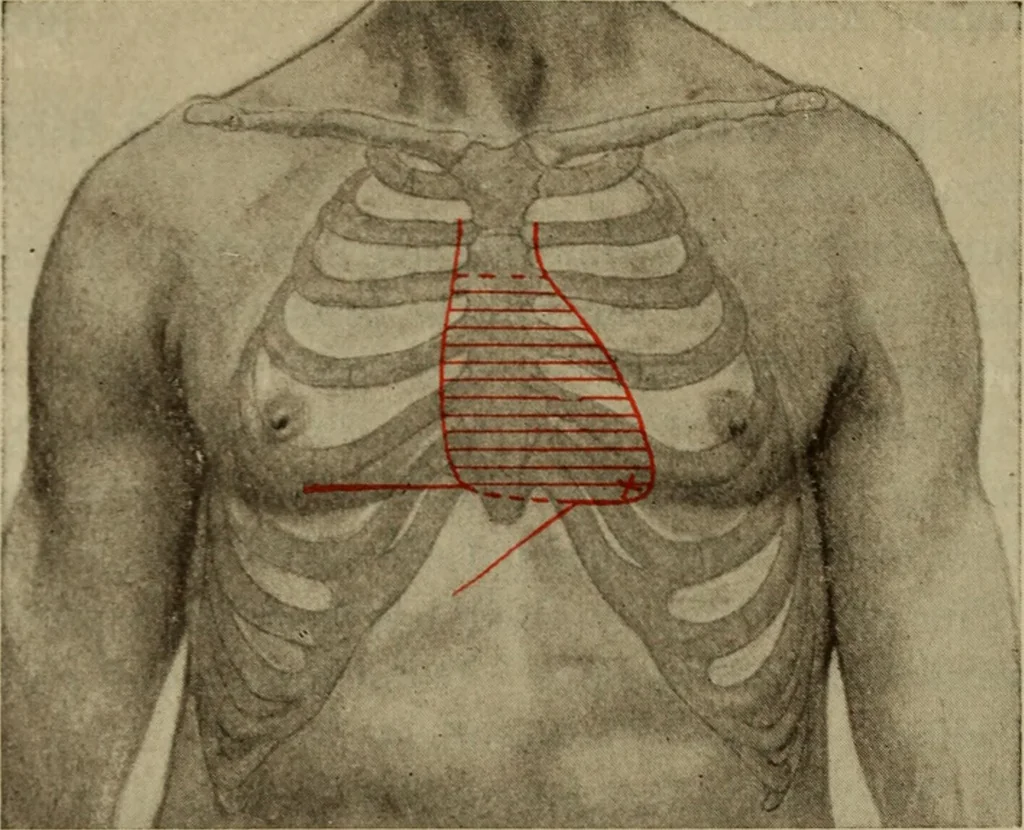 An illustration from The diagnostics of internal medicine : a clinical treatise upon the recognised principles of medical diagnosis, prepared for the use of students and practitioners of medicine / by Glentworth Reeve Butler ... ; with five coloured plates and two hundred and seventy-two illustrations and charts in the text., 1909, leaf 398