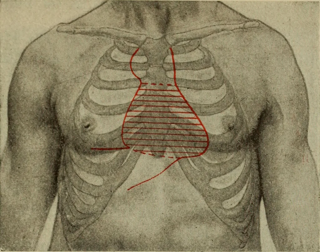 An illustration from The diagnostics of internal medicine : a clinical treatise upon the recognised principles of medical diagnosis, prepared for the use of students and practitioners of medicine / by Glentworth Reeve Butler ... ; with five coloured plates and two hundred and seventy-two illustrations and charts in the text., 1909, leaf 399