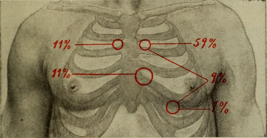 An illustration from The diagnostics of internal medicine : a clinical treatise upon the recognised principles of medical diagnosis, prepared for the use of students and practitioners of medicine / by Glentworth Reeve Butler ... ; with five coloured plates and two hundred and seventy-two illustrations and charts in the text., 1909, leaf 413