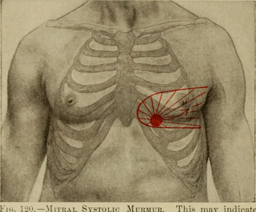 An illustration from The diagnostics of internal medicine : a clinical treatise upon the recognised principles of medical diagnosis, prepared for the use of students and practitioners of medicine / by Glentworth Reeve Butler ... ; with five coloured plates and two hundred and seventy-two illustrations and charts in the text., 1909, leaf 416