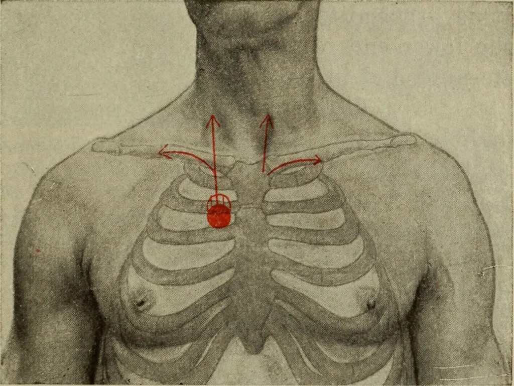 An illustration from The diagnostics of internal medicine : a clinical treatise upon the recognised principles of medical diagnosis, prepared for the use of students and practitioners of medicine / by Glentworth Reeve Butler ... ; with five coloured plates and two hundred and seventy-two illustrations and charts in the text., 1909, leaf 417