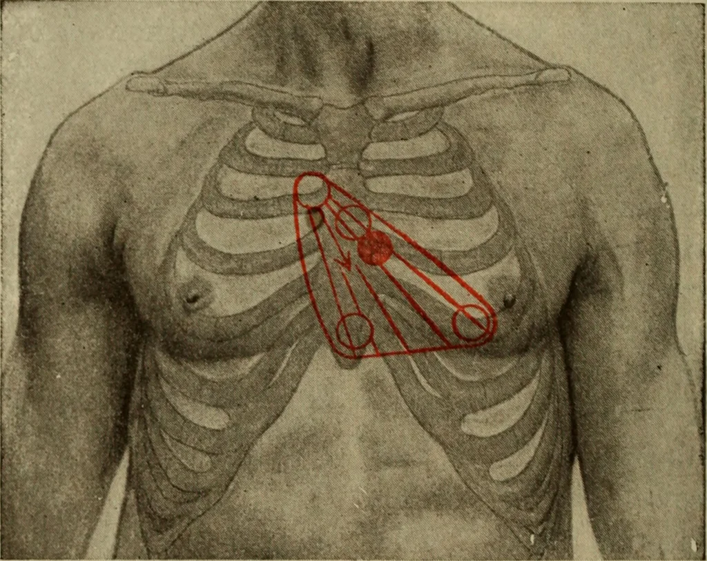 An illustration from The diagnostics of internal medicine : a clinical treatise upon the recognised principles of medical diagnosis, prepared for the use of students and practitioners of medicine / by Glentworth Reeve Butler ... ; with five coloured plates and two hundred and seventy-two illustrations and charts in the text., 1909, leaf 418