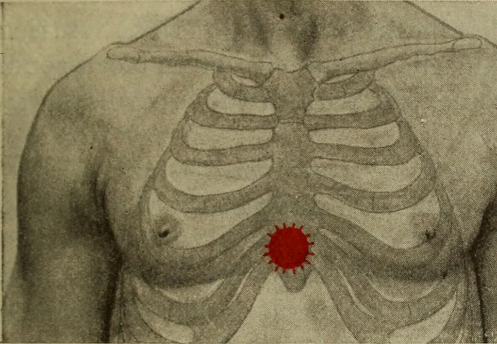 An illustration from The diagnostics of internal medicine : a clinical treatise upon the recognised principles of medical diagnosis, prepared for the use of students and practitioners of medicine / by Glentworth Reeve Butler ... ; with five coloured plates and two hundred and seventy-two illustrations and charts in the text., 1909, leaf 419