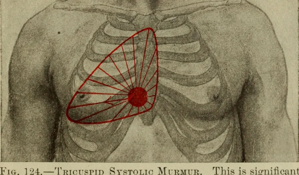 An illustration from The diagnostics of internal medicine : a clinical treatise upon the recognised principles of medical diagnosis, prepared for the use of students and practitioners of medicine / by Glentworth Reeve Butler ... ; with five coloured plates and two hundred and seventy-two illustrations and charts in the text., 1909, leaf 419