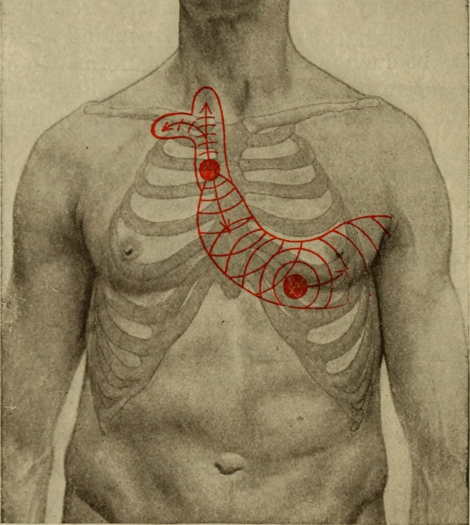 An illustration from The diagnostics of internal medicine : a clinical treatise upon the recognised principles of medical diagnosis, prepared for the use of students and practitioners of medicine / by Glentworth Reeve Butler ... ; with five coloured plates and two hundred and seventy-two illustrations and charts in the text., 1909, leaf 422