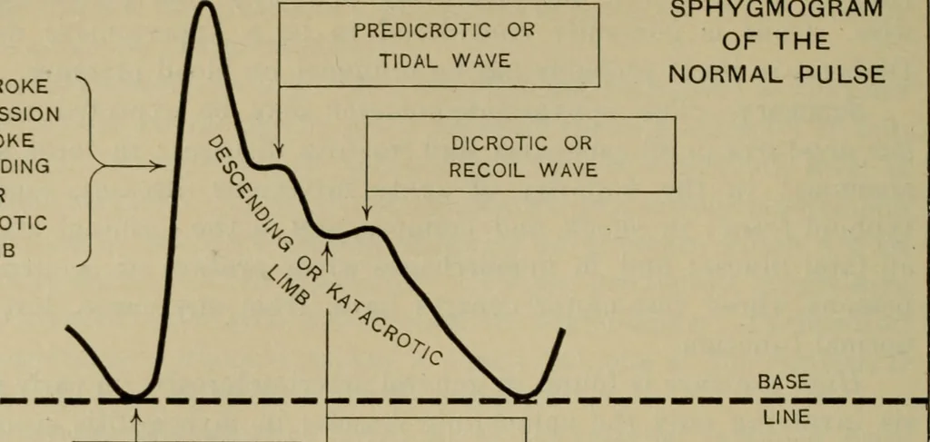An illustration from The diagnostics of internal medicine : a clinical treatise upon the recognised principles of medical diagnosis, prepared for the use of students and practitioners of medicine / by Glentworth Reeve Butler ... ; with five coloured plates and two hundred and seventy-two illustrations and charts in the text., 1909, leaf 446