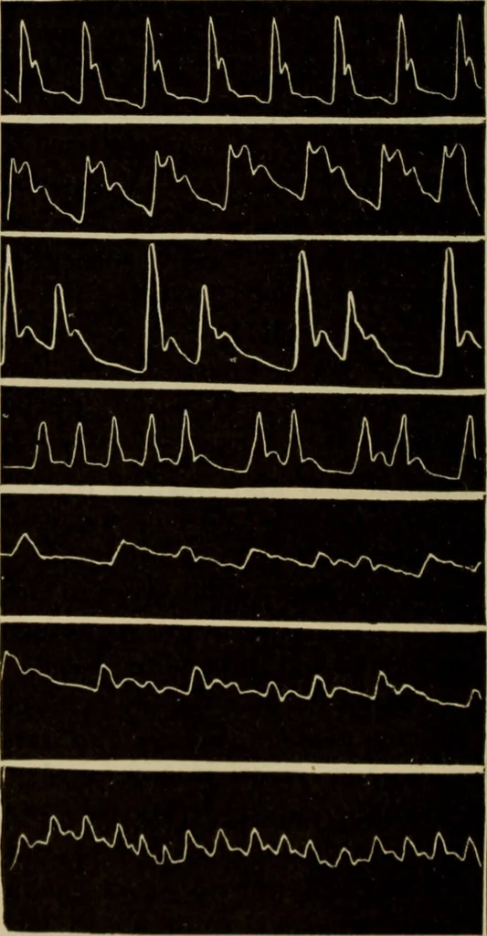 An illustration from The diagnostics of internal medicine : a clinical treatise upon the recognised principles of medical diagnosis, prepared for the use of students and practitioners of medicine / by Glentworth Reeve Butler ... ; with five coloured plates and two hundred and seventy-two illustrations and charts in the text., 1909, leaf 446